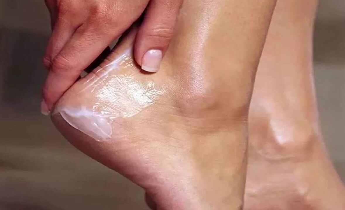 Wie man Fußpilz mit Fungent Creme behandelt