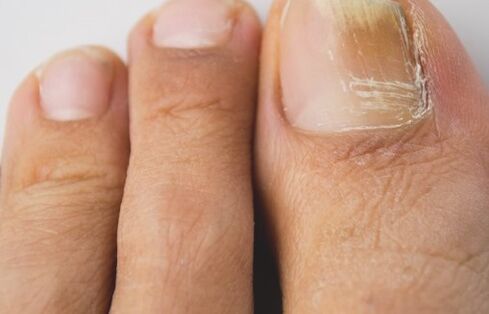 Nagelpilz