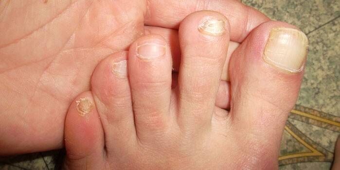 Aktualisieren des Nagels nach einer Verletzung