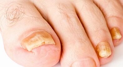 wie man Nagelpilz behandelt
