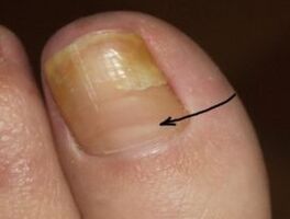 Wie man das Vorhandensein eines Nagelpilzes am Daumen des Beins erkennt