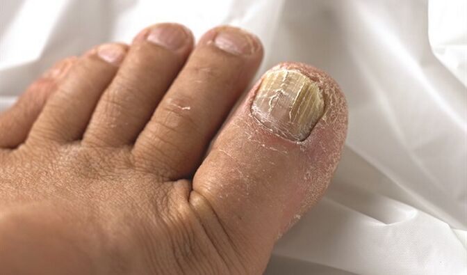 Verbreitung von Myosläsion auf die Nagelplatte