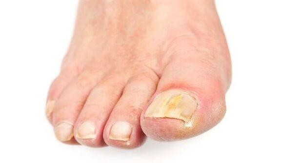 Gelbfärbung des Nagels aufgrund einer Pilzinfektion