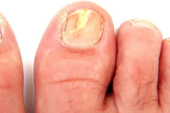 Beschädigung der Nagelplatte durch eine Pilzinfektion