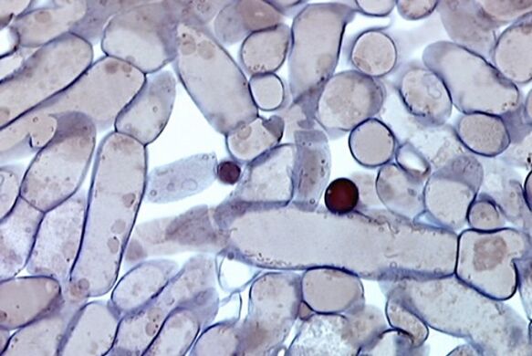 Nagelpilzzellen unter dem Mikroskop