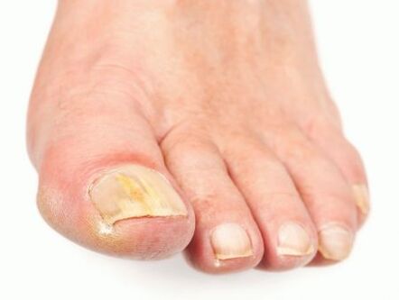 Nagelpilzschäden