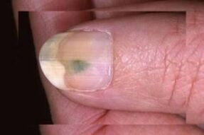 Pilzinfektion der Nagelplatte