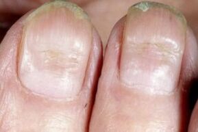 Symptome eines Nagelpilzes