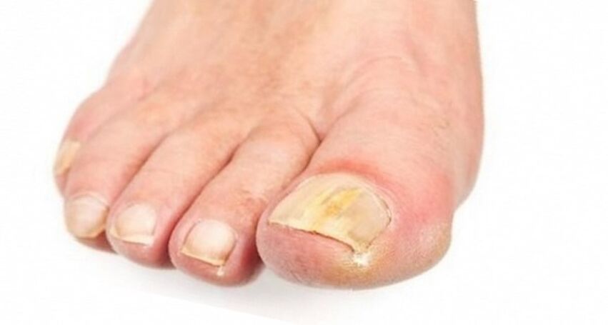 Gelbfärbung des Nagels durch Pilz