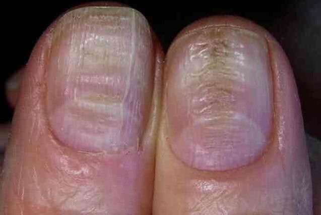 Pilzinfektion der Nagelplatte