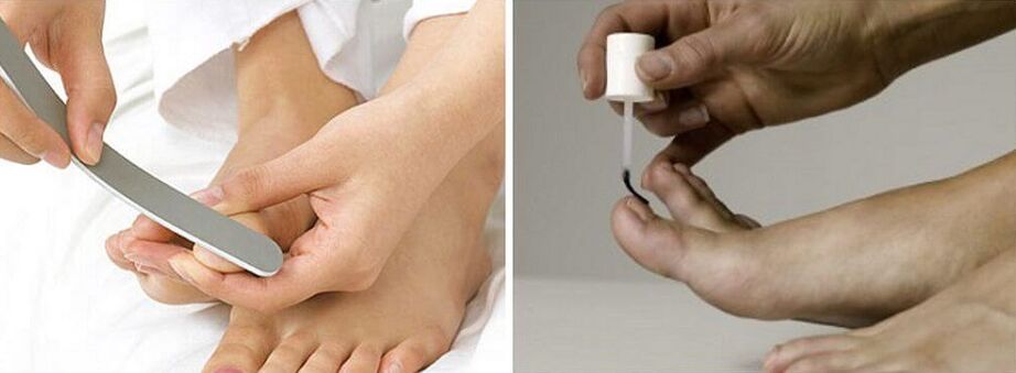 Behandlung von Nagelpilz mit Lack